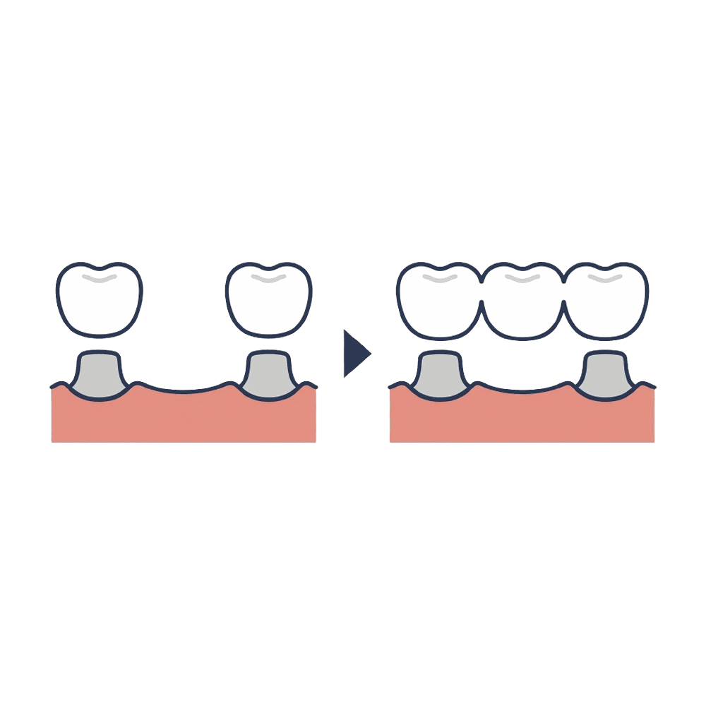 ブリッジの仕組み（欠損補綴）のイラスト素材