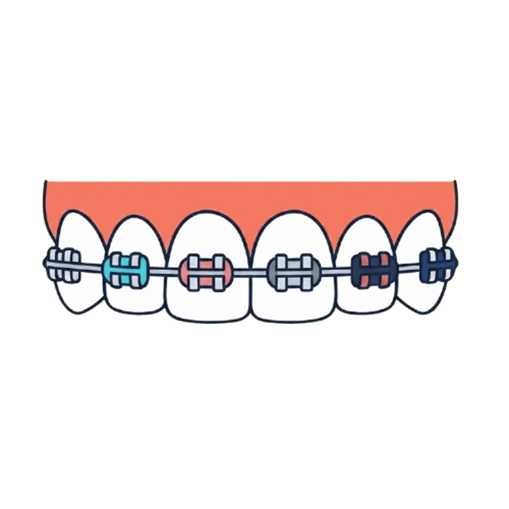 ブラケットとワイヤーのイラスト素材