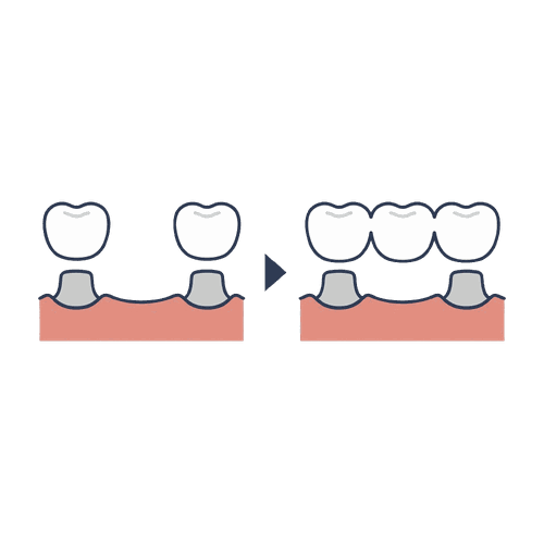 ブリッジの仕組み（欠損補綴）のイラスト素材