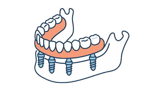 インプラントオーバーデンチャーのイラスト素材