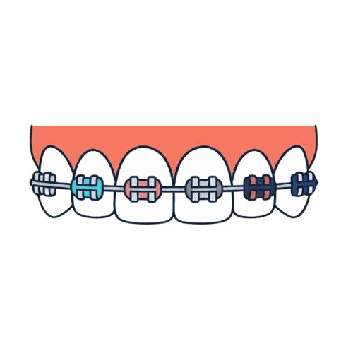 ブラケットとワイヤーのイラスト素材